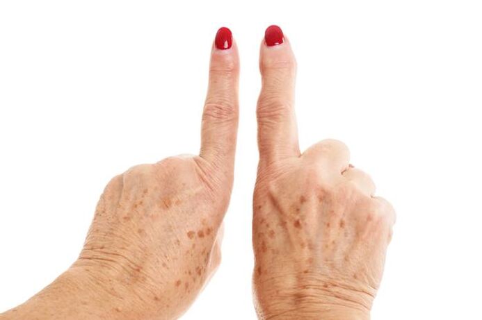 deformujúca artróza na prstoch