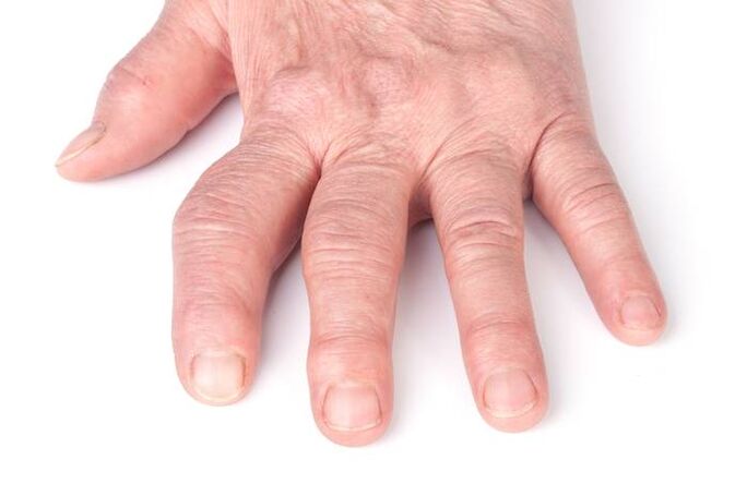 deformujúca artróza na rukách