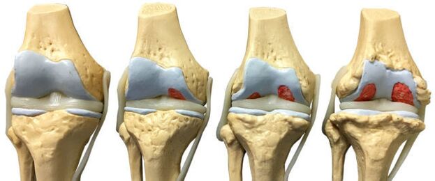 poškodenie kĺbov v rôznych fázach vývoja artrózy členku