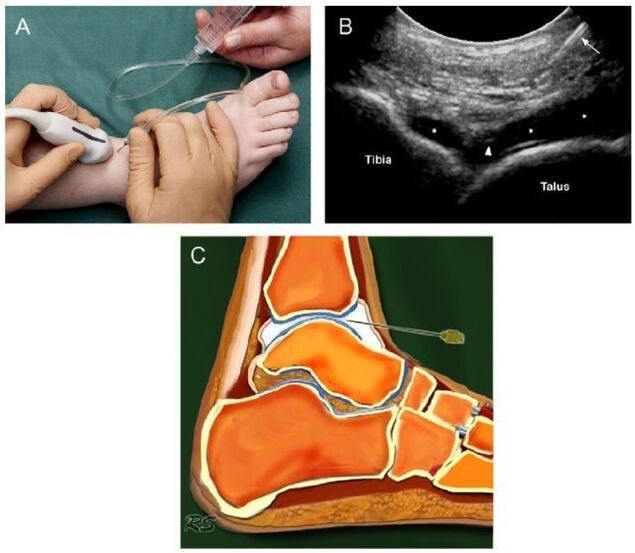 ultrazvuk členkového kĺbu s artrózou