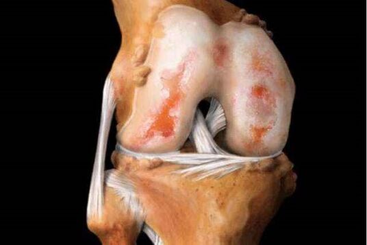 poškodenie kolenného kĺbu s artrózou