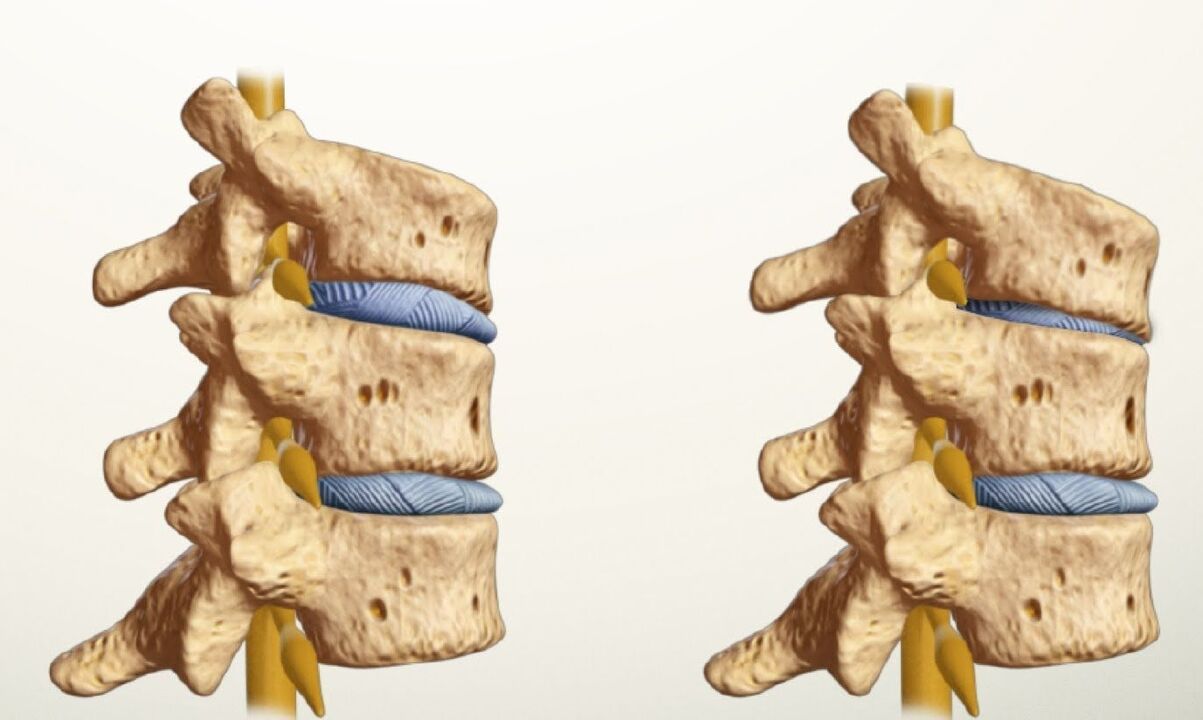 zdravá a chorá chrbtica s bedrovou osteochondrózou