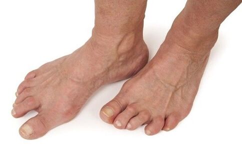 nohy postihnuté artrózou