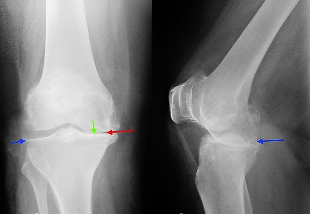 röntgen artrózy kolenného kĺbu