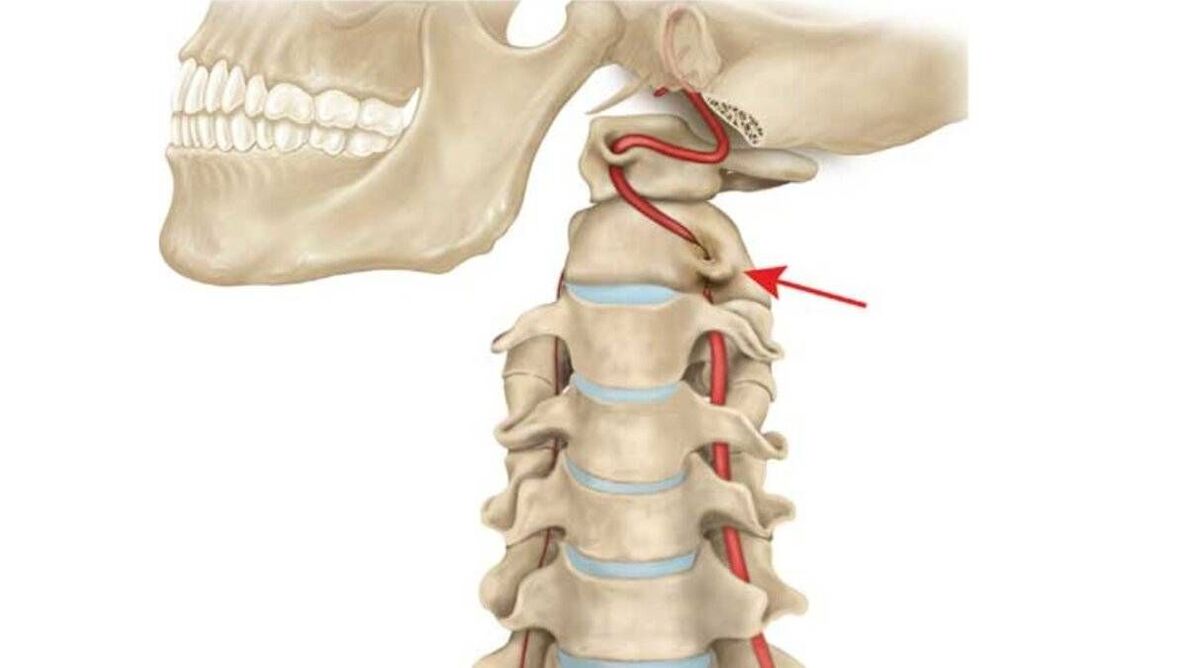 osteochondróza krčnej chrbtice