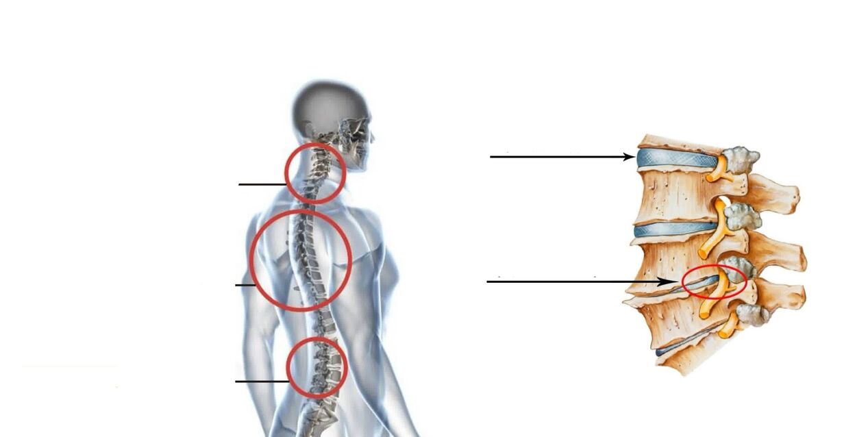 ostechondróza chrbtice