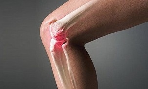 ako sa artritída líši od artrózy