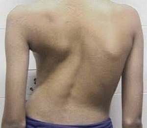 skolióza ako príčina bolesti chrbta