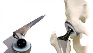artroplastika bedrového kĺbu pre artrózu