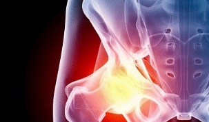 dôvody pre vznik artrózy bedrového kĺbu