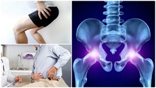 klasifikácia osteochondrózy chrbtice