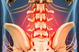 príčiny a príznaky osteochondrózy
