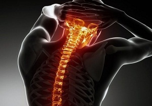 pravidlá liečby osteochondrózy krčnej chrbtice