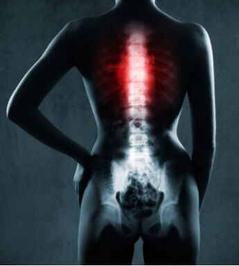 Ovplyvnená oblasť chrbtice s hrudnou osteochondrózou