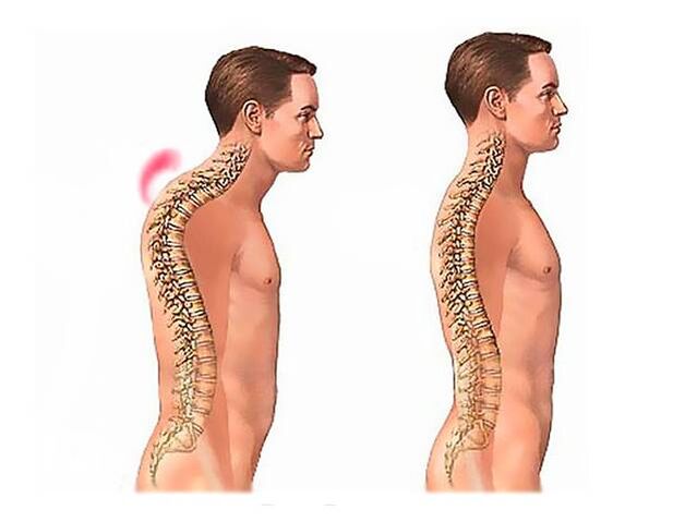Kyfóza chrbtice