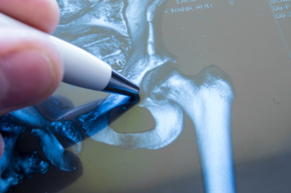 Artróza bedrového kĺbu na röntgenograme