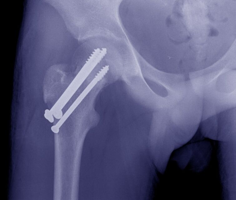 RTG bedrového kĺbu, osteosyntéza zlomeniny pomocou vnútorných fixačných zariadení