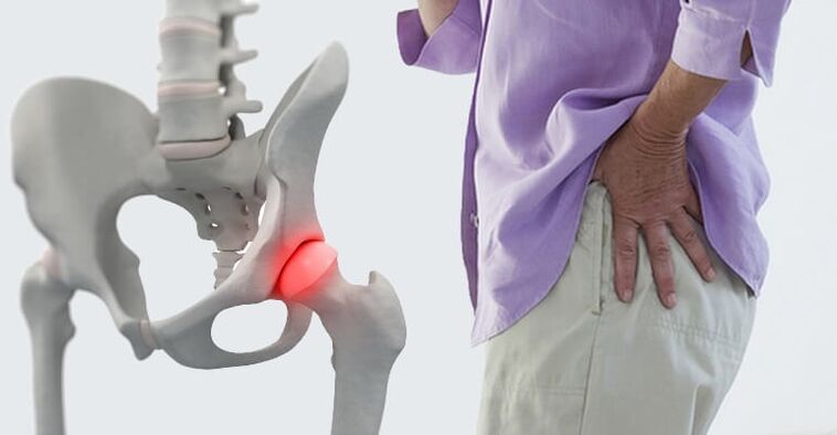 bolesť v oblasti bedrového kĺbu - príznak artrózy bedrového kĺbu