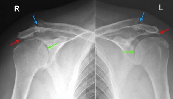 Röntgen ramenných kĺbov